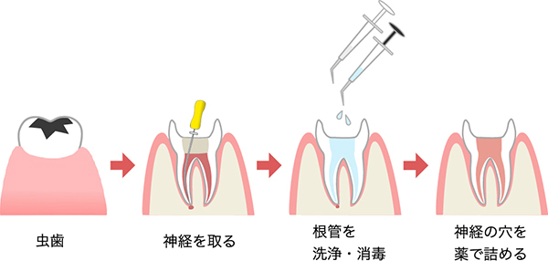 根管治療とは？