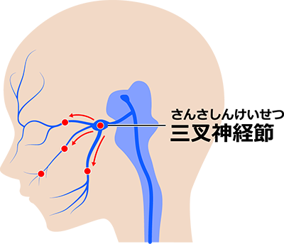 三叉神経痛