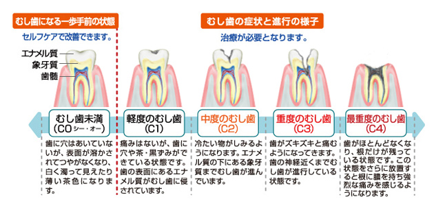 虫歯の進行状況